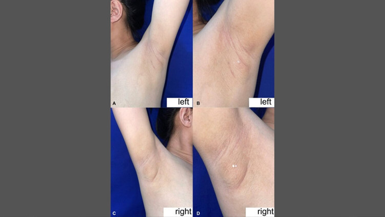 filipinli kadinin koltukaltindan sut geldi nadir gorulen durumun nedeni ne nKAmXJ4O.jpg